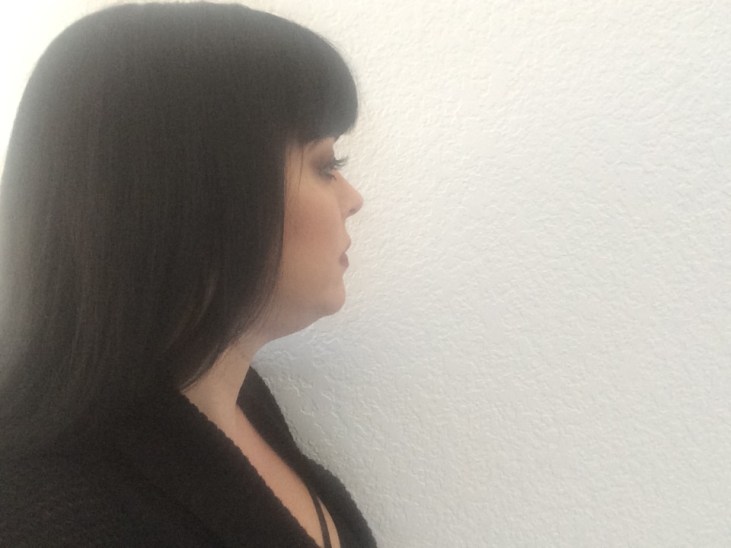 kybella after treatment 2